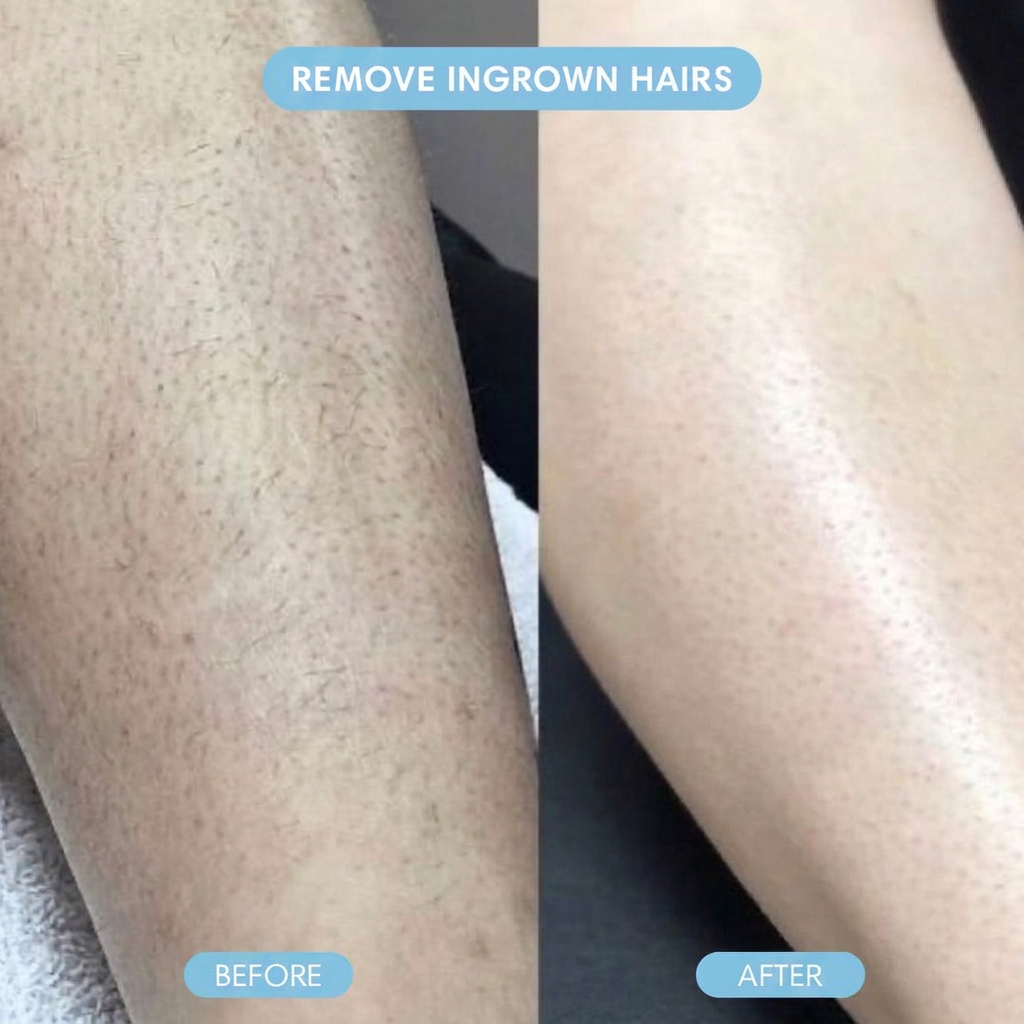 Novium Cyrstal Hair Eraser