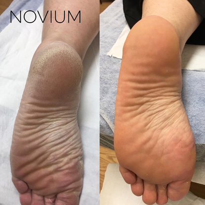 Novium Premium Foot Callus Remover