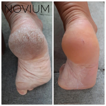 Novium Premium Foot Callus Remover